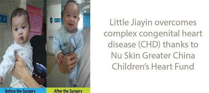 Little Jiayin overcomes complex congenital heart disease (CHD) thanks to Nu Skin Greater China Children's Heart Fund.