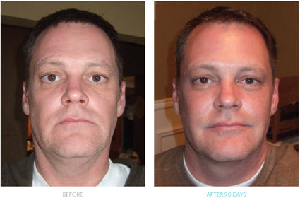 ageLOC_before&after_michael_wilfong